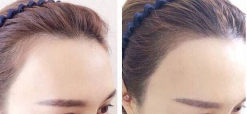 杭州疤痕整形哪家醫(yī)院好？選擇哪個(gè)醫(yī)院更靠譜？