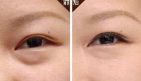 沈陽(yáng)哪家醫(yī)院做脂肪隆胸效果好且價(jià)格合理？