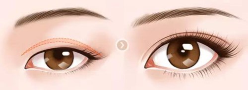 武漢美立方的胡江偉如何進(jìn)行雙眼皮手術(shù)？