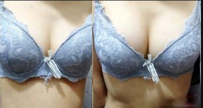 廣州哪家醫(yī)院的乳頭凹陷術效果好？