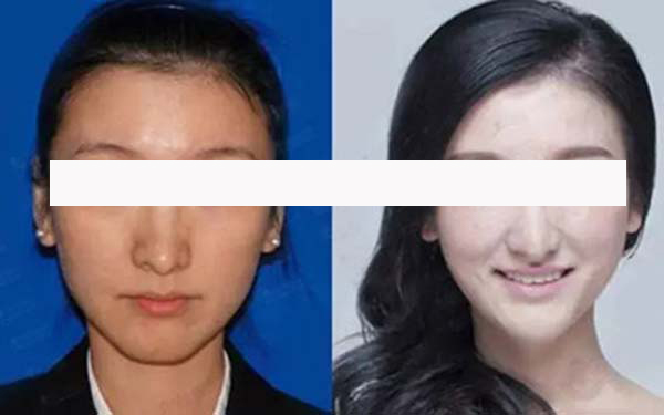 四川省人民醫(yī)院杜麗平醫(yī)生指導：告別眼袋，銘記眼部衰老防范重要