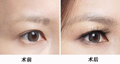 北京八大處醫(yī)院大牌醫(yī)生推薦！專治雙眼皮！