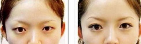 深圳眼袋手術哪家醫(yī)院最靠譜？