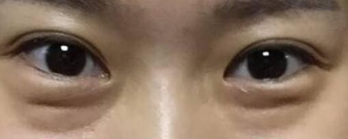 蘇薇潔與楊亞益哪位更適合做雙眼皮？上海美眼大咖實力測評揭曉，你怎么決策？