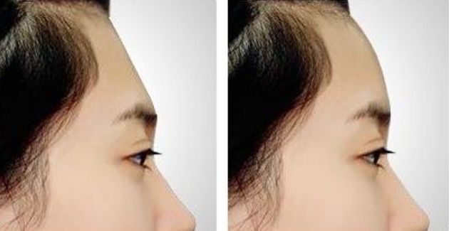 南京割雙眼皮哪家醫(yī)院效果好？
