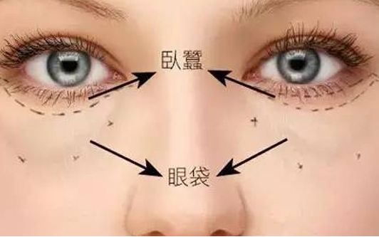 海口哪家醫(yī)院做眼袋效果好？