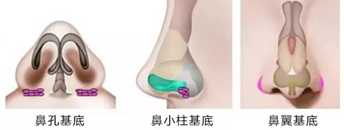 上海王艷醫(yī)生鼻部整形效果及價格匯總