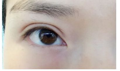 南昌祛痘哪家醫(yī)院口碑好，效果最佳？