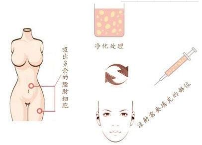 廣州燒傷疤痕治療哪家醫(yī)院效果好，選擇哪家醫(yī)院最靠譜？