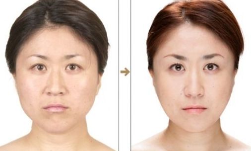 杭州整形醫(yī)院的抽脂效果如何？哪家醫(yī)院抽脂好？