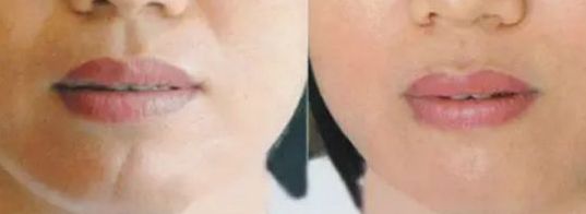 上海面部除疤效果最好的醫(yī)院有哪些？