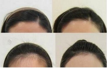 哈爾濱皮秒手術(shù)哪家醫(yī)院好？全面評(píng)測(cè)哈爾濱皮秒醫(yī)院排名