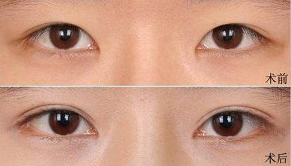 大連假體隆鼻哪家醫(yī)院好？打造完美鼻型，這家醫(yī)院是最佳選擇！