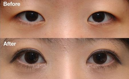 杭州雙眼皮醫(yī)院排名Top1，哪家醫(yī)院做雙眼皮效果好？