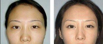 重慶去眼袋哪家醫(yī)院好？選擇靠譜的醫(yī)療機構，功效更可靠！