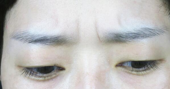 林沸騰整形醫(yī)院福州隆胸手術(shù)效果評價