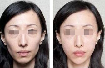 深圳蛋白線提升面部醫(yī)院排名及費用對比-找到最適合你的提升方案