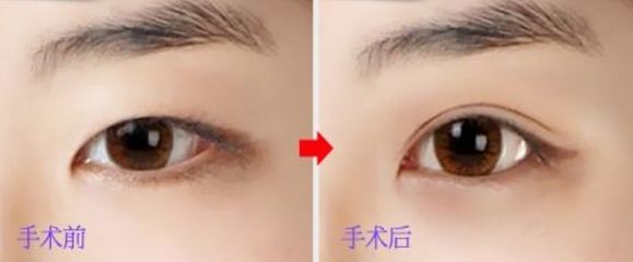 上海玻尿酸豐唇哪家醫(yī)院好？挑選上海口碑好的玻尿酸豐唇醫(yī)院