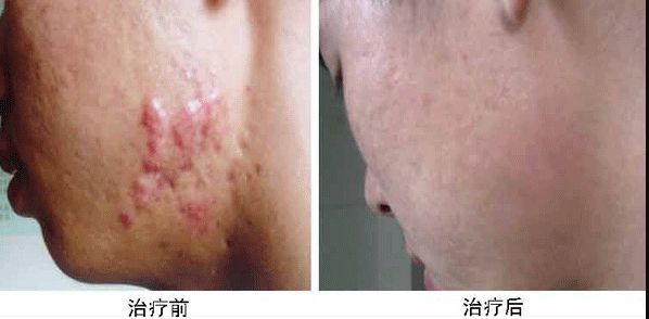 深圳哪家醫(yī)院隆胸效果好，費用適中？