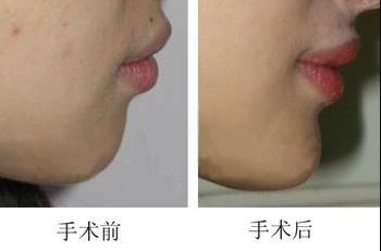 昆明哪家醫(yī)院做上臉下垂手術(shù)好，醫(yī)生技術(shù)靠譜？