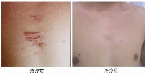 2023長沙微整形祛疤祛痘排行榜十強(qiáng)專家(張嬌嬌、劉俐婧、陳詠玲詳版簡介展示!)
