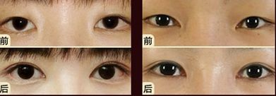 嘟嘟唇無錫哪家醫(yī)院好？專家推薦無錫哪家醫(yī)院治療嘟嘟唇好