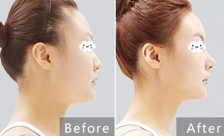 貴陽治療痘坑哪家醫(yī)院專業(yè)可靠？