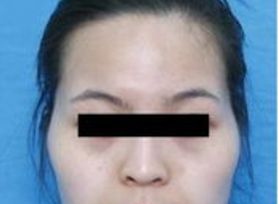 成都治療臉上痘痘哪家醫(yī)院好？專家推薦的成都治痘好醫(yī)院大揭秘！
