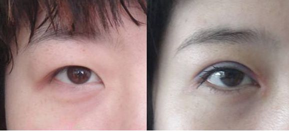 上海市激光修復(fù)痘坑效果如何？哪家醫(yī)院技術(shù)更好？