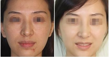 沈陽眼袋整形哪家醫(yī)院好？