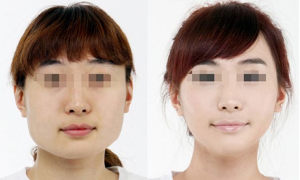 合肥哪家醫(yī)院豐胸效果好，專業(yè)的豐胸醫(yī)院推薦