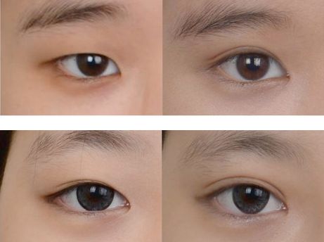 修復(fù)過寬雙眼皮手術(shù)，寬度調(diào)整方案推薦