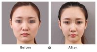 矯正牙齒需預(yù)估費(fèi)用？費(fèi)用注意事項(xiàng)解析！