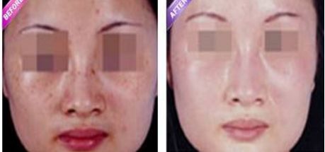 激光縮陰是否會導(dǎo)致副作用？找到安全有效的解決方法