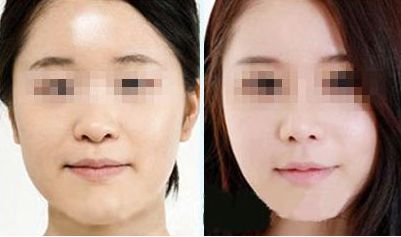 激光去除眼袋，持久效果有多久？?jī)r(jià)格如何，眼周抗衰秘笈大揭示