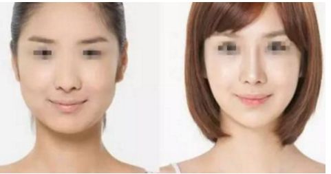 威寧隆胸手術(shù)效果如何？術(shù)后持久無需擔(dān)心！