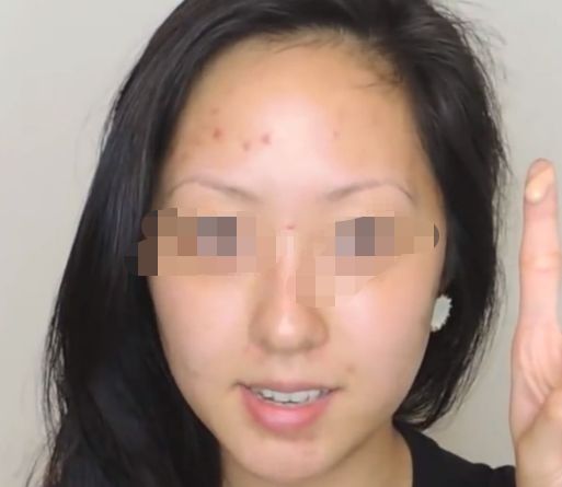 延長(zhǎng)透明質(zhì)酸隆鼻效果，多種小竅門讓您保持完美鼻形
