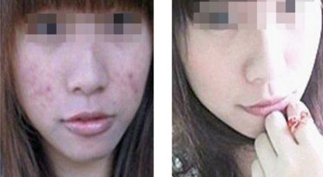 危害程度如何？全方位解析臉部拉皮手術(shù)風(fēng)險與安全