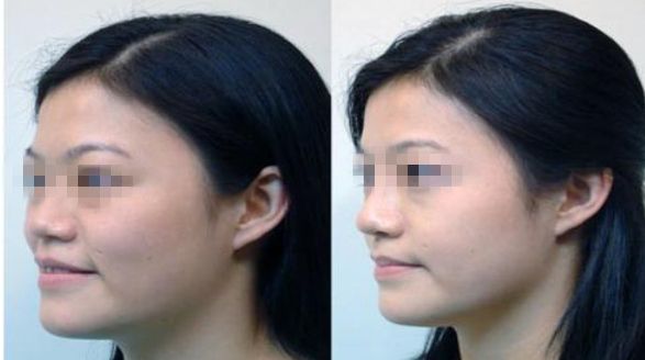 面部輪廓整形：手術解析及常見技術解讀