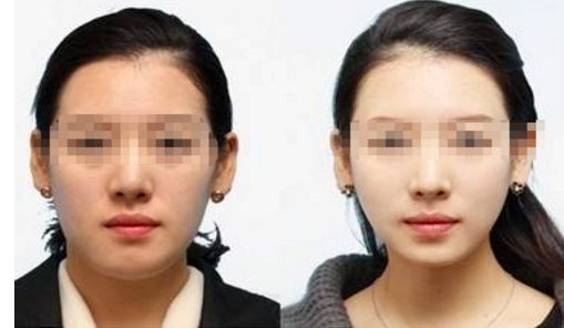 彩光嫩膚：一個療程要多少次才有效？