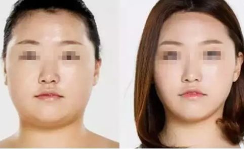 如何瘦腿？吸脂還是塑形？方法對比與價(jià)格解析