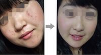 手臂吸脂前的準備：如何做好術(shù)前準備