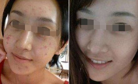 腿部吸脂術(shù)后出現(xiàn)腳腫現(xiàn)象，如何緩解？