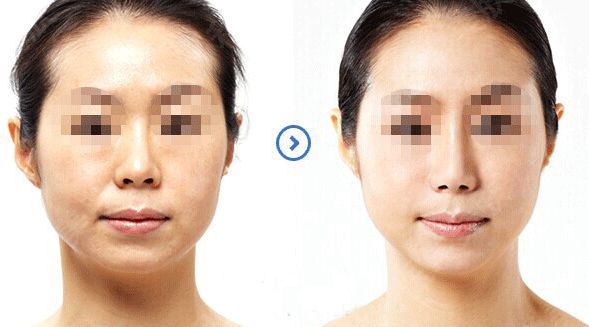 想要塑造完美鼻型？了解全肋骨隆鼻手術嗎？