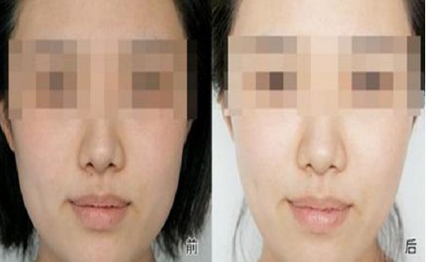 修復雙眼皮失敗的方法與效果，全面解析助你成功擁有完美雙眼皮