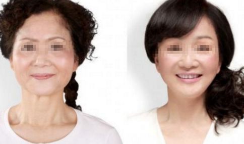 腹部抽脂術的疼痛感受，了解一下!