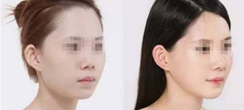 假體隆鼻手術(shù)帶來正自然效果，狀似真實鼻形