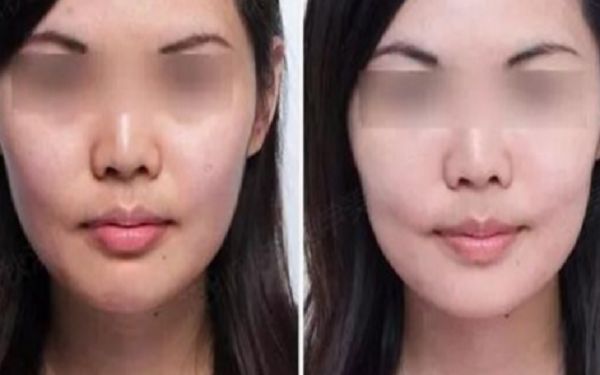 35歲采用超聲療程好還是熱瑪吉更好？匿名評(píng)測揭秘！