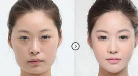 皮膚松弛，如何選擇適合的醫(yī)美項(xiàng)目？熱門方式如熱瑪吉、拉皮等對比解析！