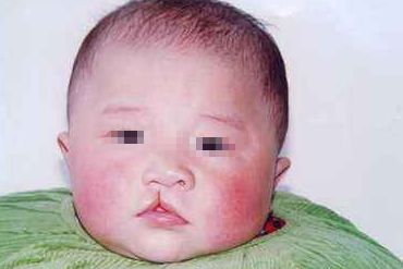 處女膜修復(fù)術(shù)后多久能恢復(fù)正常？